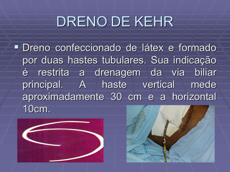 DRENO DE KEHR