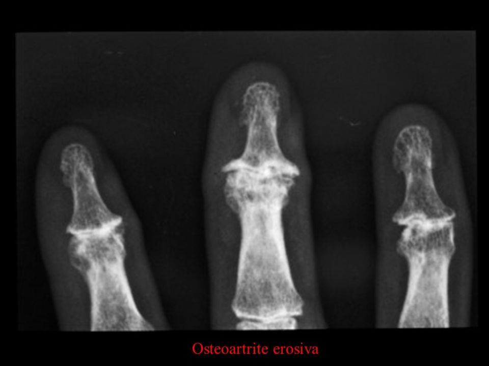 Osteoartrita Erozivă A Mâinilor BOALA ARTROZICA