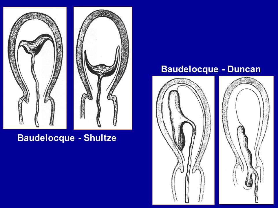 Mecanismo de parto e assistência clínica ao parto Baudelocque+-+Duncan+Baudelocque+-+Shultze