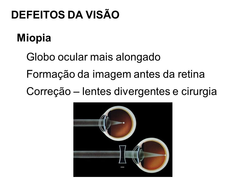 DEFEITOS DA VISÃO Miopia. Globo ocular mais alongado.