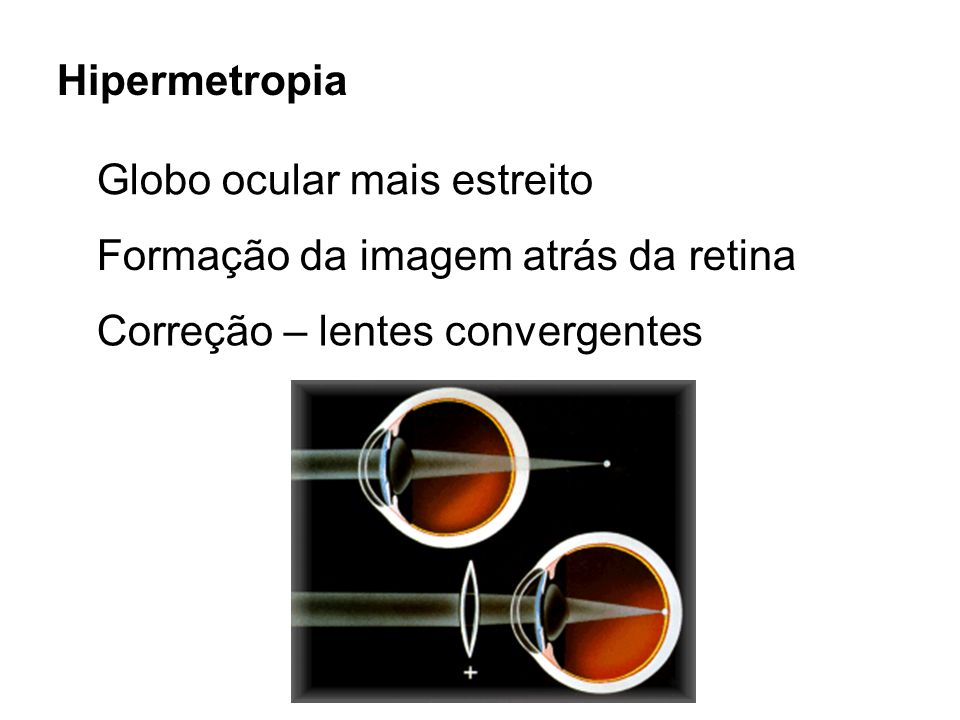 Hipermetropia Globo ocular mais estreito. Formação da imagem atrás da retina.