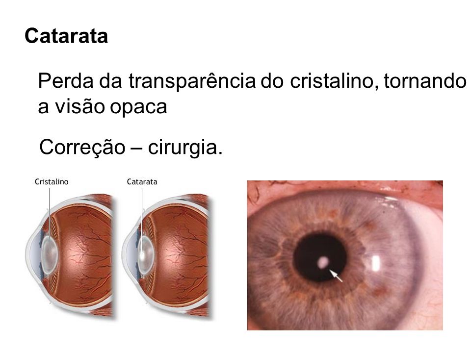 Catarata Perda da transparência do cristalino, tornando a visão opaca Correção – cirurgia.