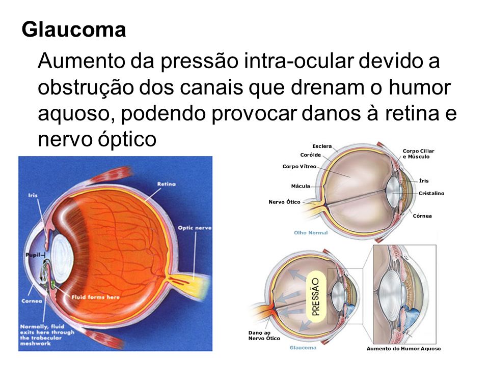 Glaucoma Aumento da pressão intra-ocular devido a. obstrução dos canais que drenam o humor. aquoso, podendo provocar danos à retina e.