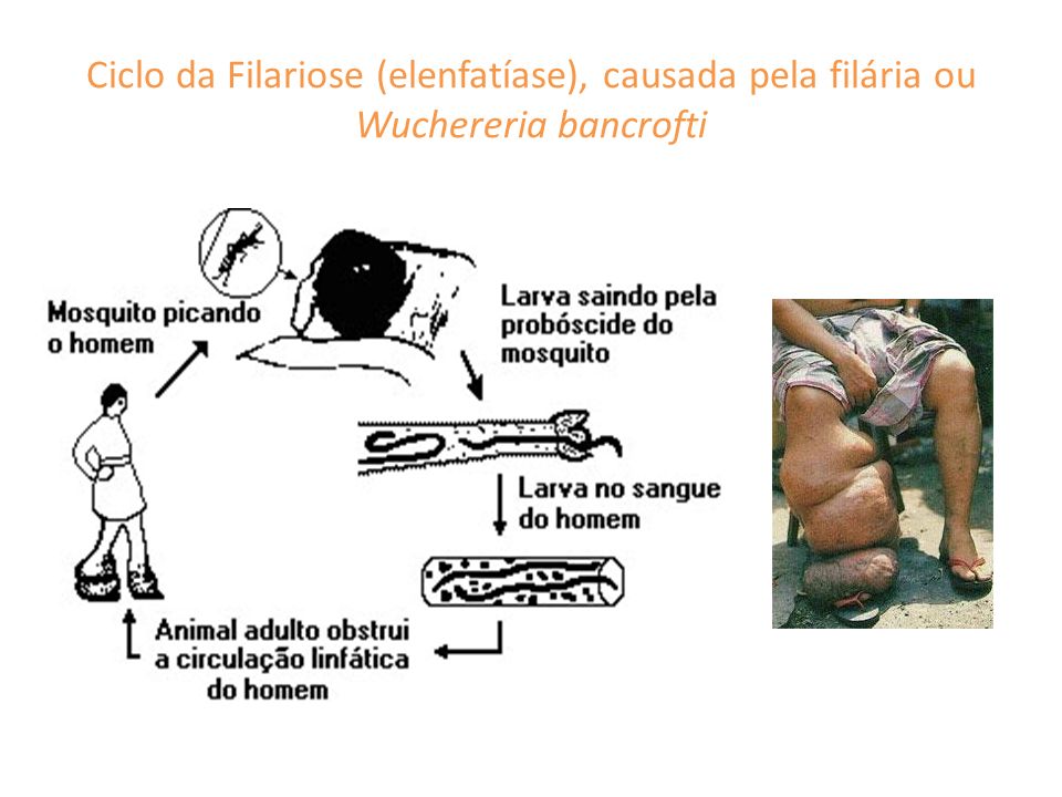 Ciclo da Filariose (elenfatíase), causada pela filária ou Wuchereria bancrofti