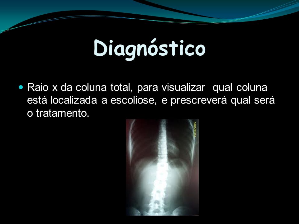 Diagnóstico Raio x da coluna total, para visualizar qual coluna está localizada a escoliose, e prescreverá qual será o tratamento.