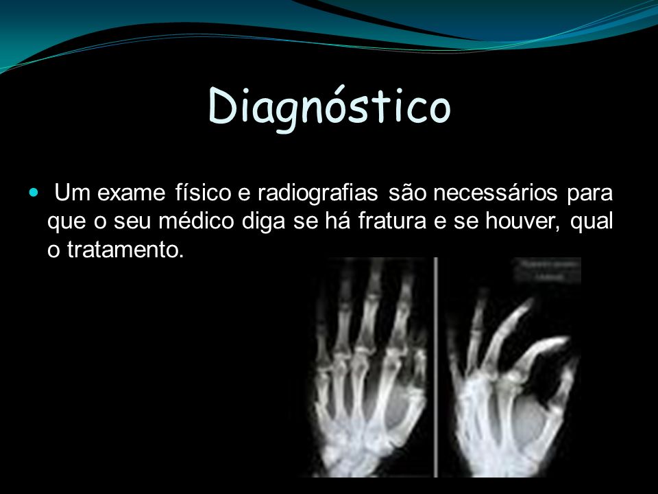 Diagnóstico Um exame físico e radiografias são necessários para que o seu médico diga se há fratura e se houver, qual o tratamento.
