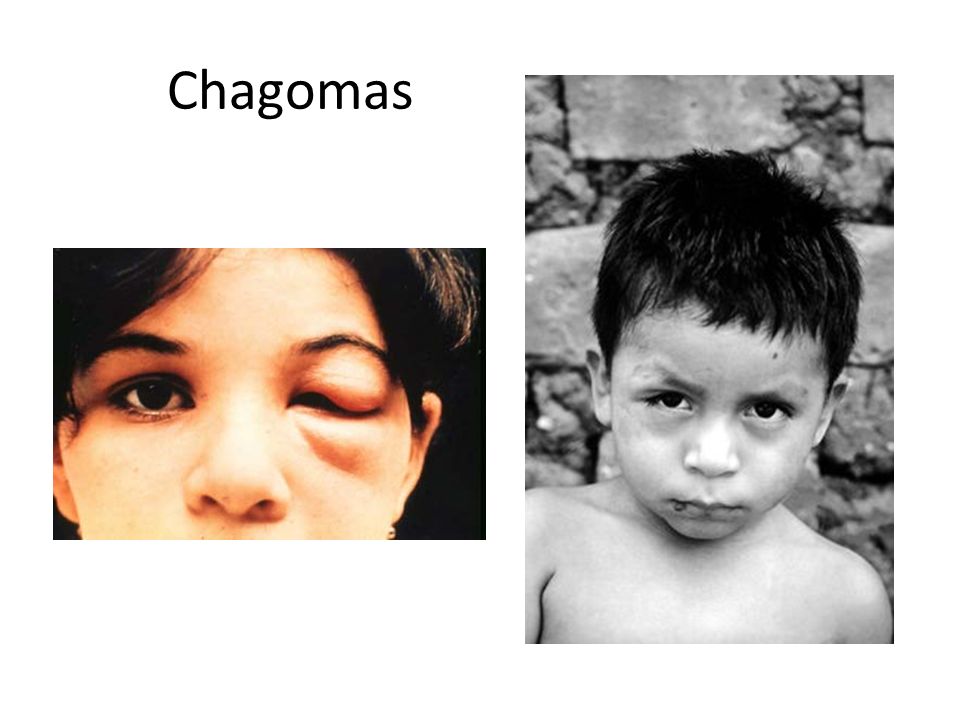 Chagomas