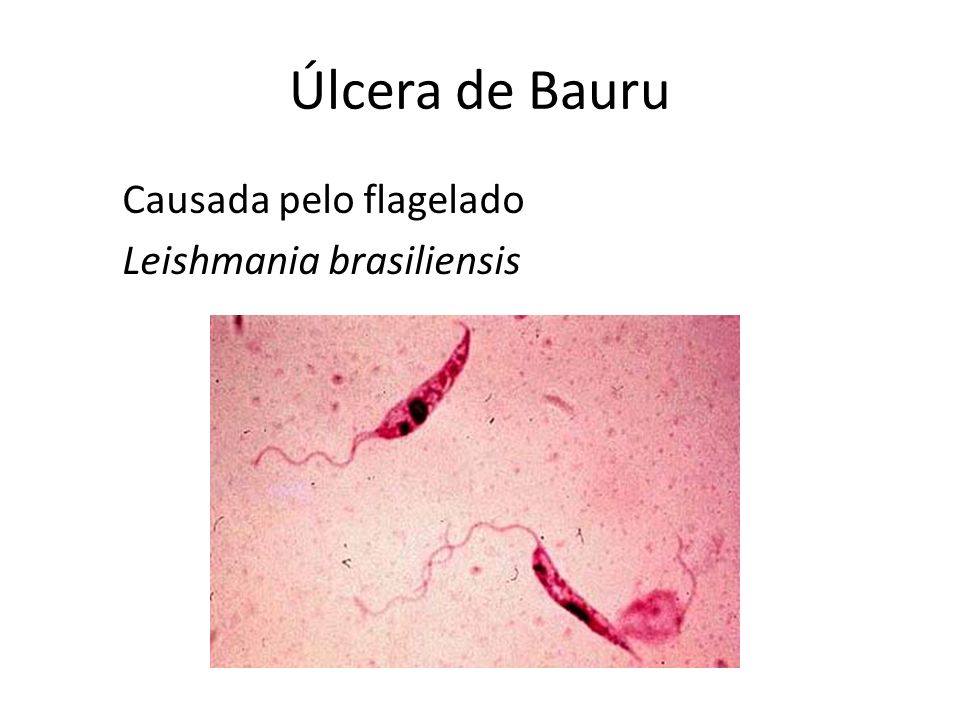 Úlcera de Bauru Causada pelo flagelado Leishmania brasiliensis