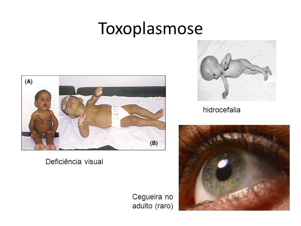 Toxoplasmose hidrocefalia Deficiência visual Cegueira no adulto (raro)