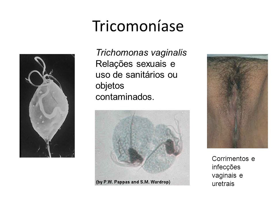 Tricomoníase Trichomonas vaginalis