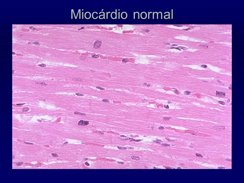 Miocárdio normal