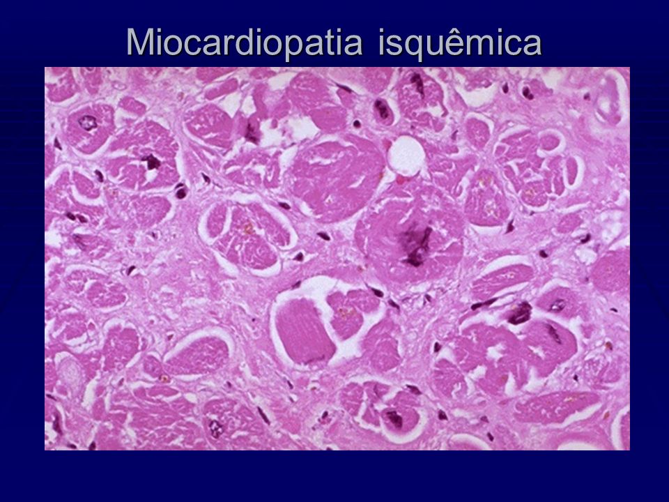 Miocardiopatia isquêmica