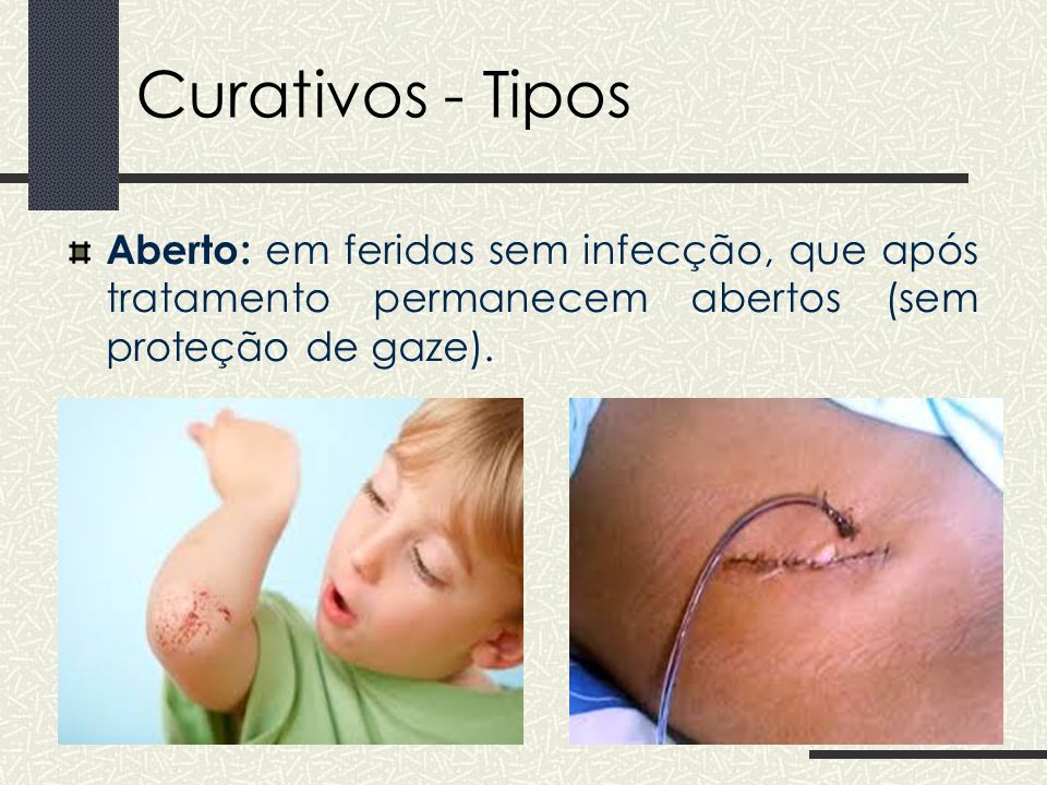 Curativos - Tipos Aberto: em feridas sem infecção, que após tratamento permanecem abertos (sem proteção de gaze).