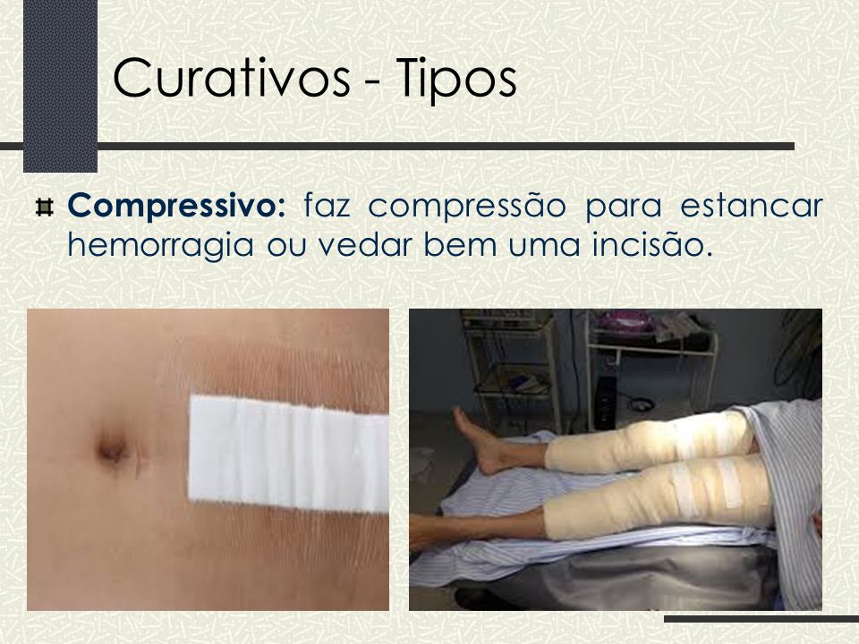 Curativos - Tipos Compressivo: faz compressão para estancar hemorragia ou vedar bem uma incisão.