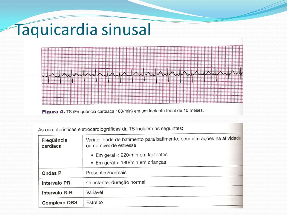 Taquicardia sinusal