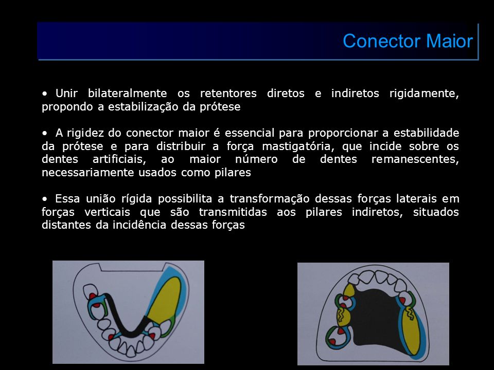 Conector Maior Unir bilateralmente os retentores diretos e indiretos rigidamente, propondo a estabilização da prótese.