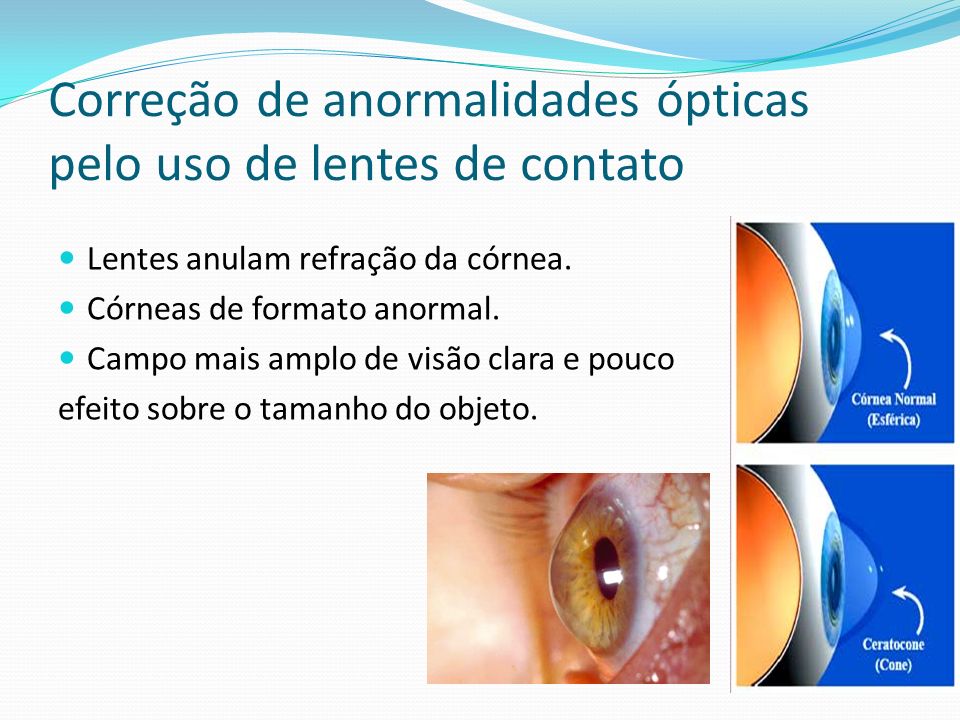 Correção de anormalidades ópticas pelo uso de lentes de contato