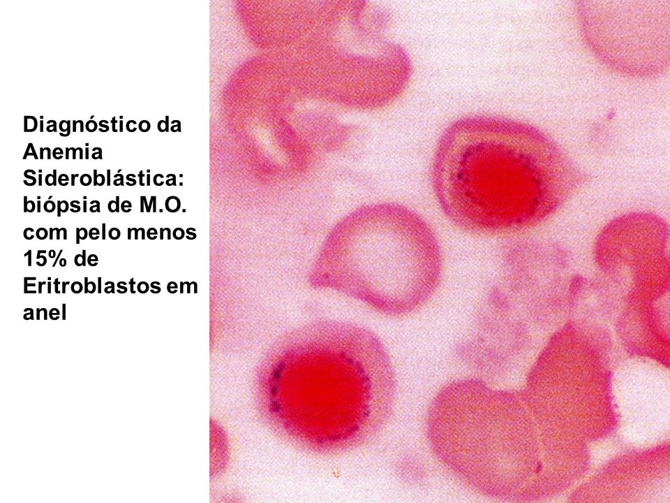Metabolismo da Hemoglobina e Classificação das Anemias - ppt video online  carregar